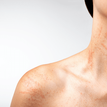 Eczeem | Allergische huid