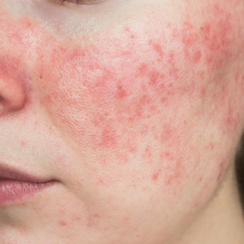 Couperose | Rosacea